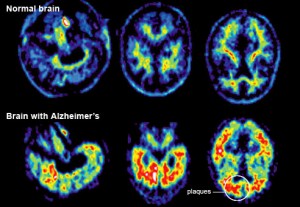 Alzheimer-cerebro